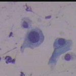 Κυτταρο ενδοτραχήλου με διογκωμένο πυρήνα.